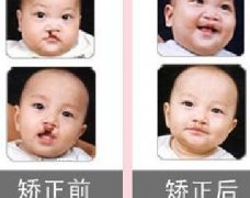 吃兔肉真的會(huì)長(zhǎng)兔唇？為什么會(huì)長(zhǎng)兔唇？